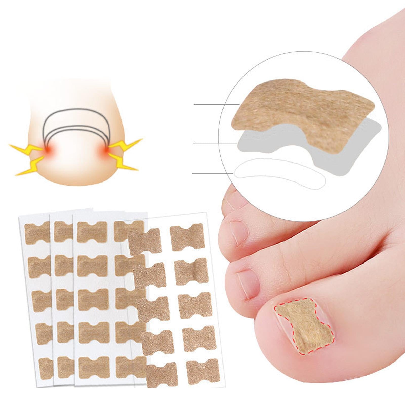 100x Ingrown Toenail Corrector Stickers Toenail Patch for Pedicure Tools White