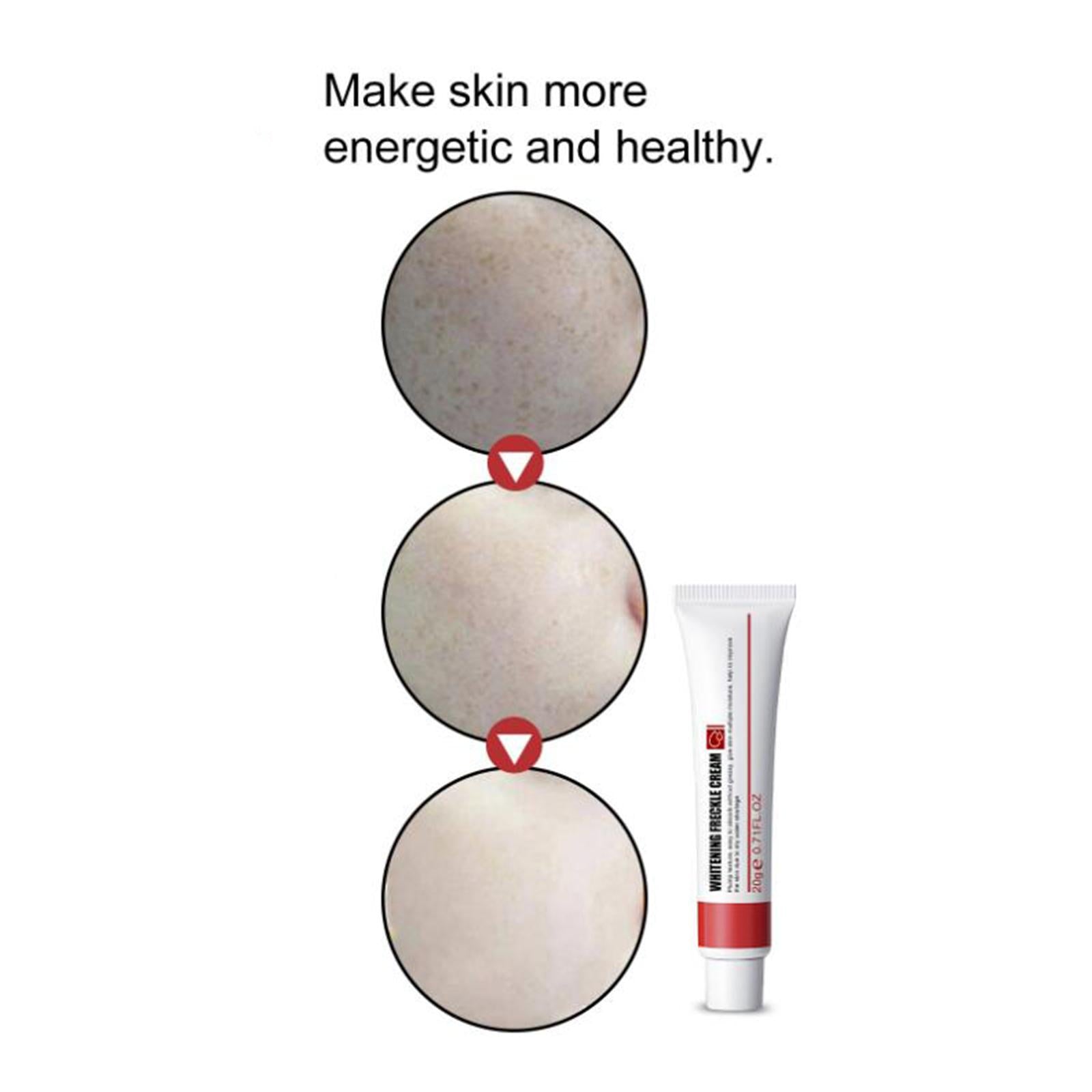 5xFreckle Cream Moisturizer Repair Cream for Melasma Dark Spots Moisturizing