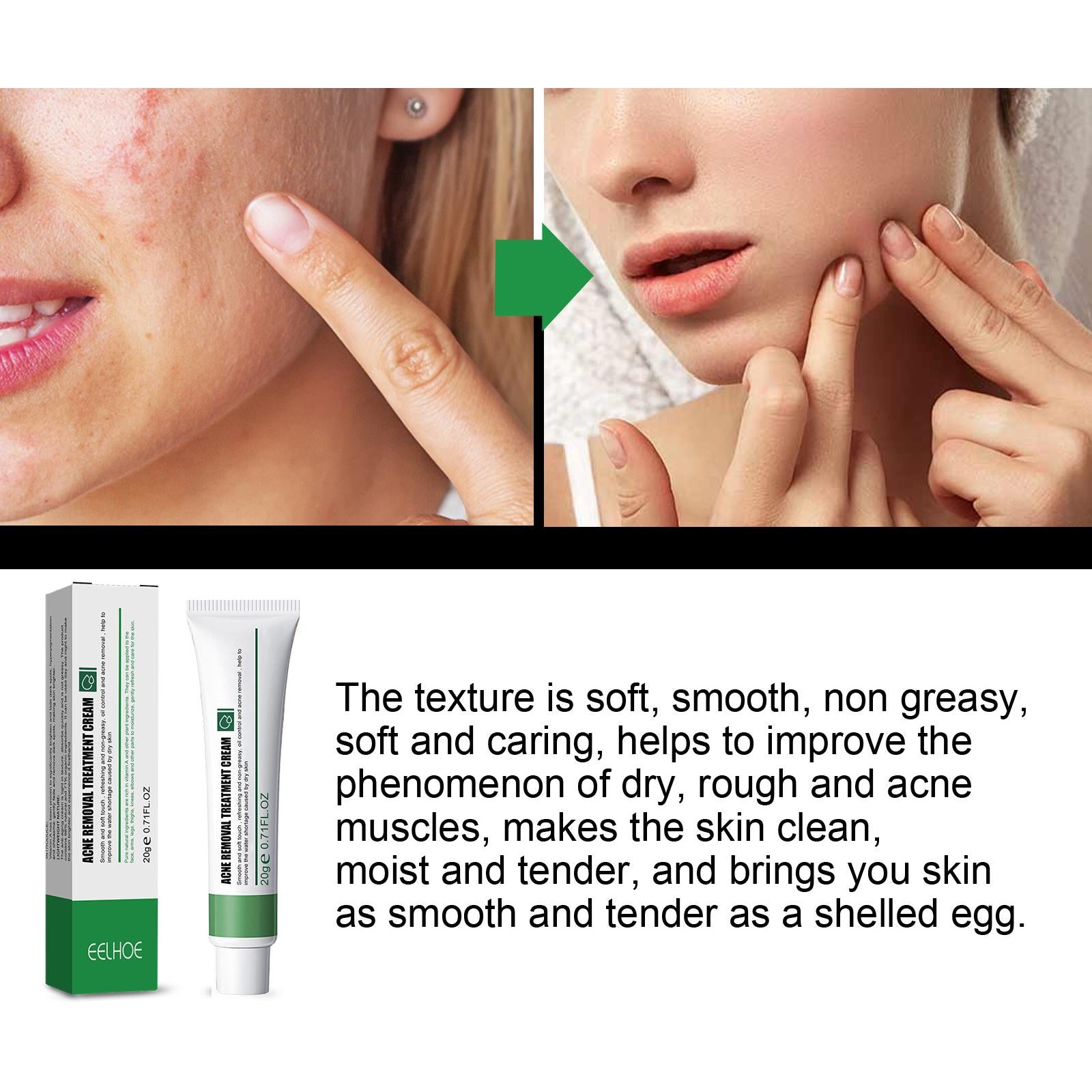 4xFreckle Cream Moisturizer Repair Cream for Melasma Dark Spots Moisturizing