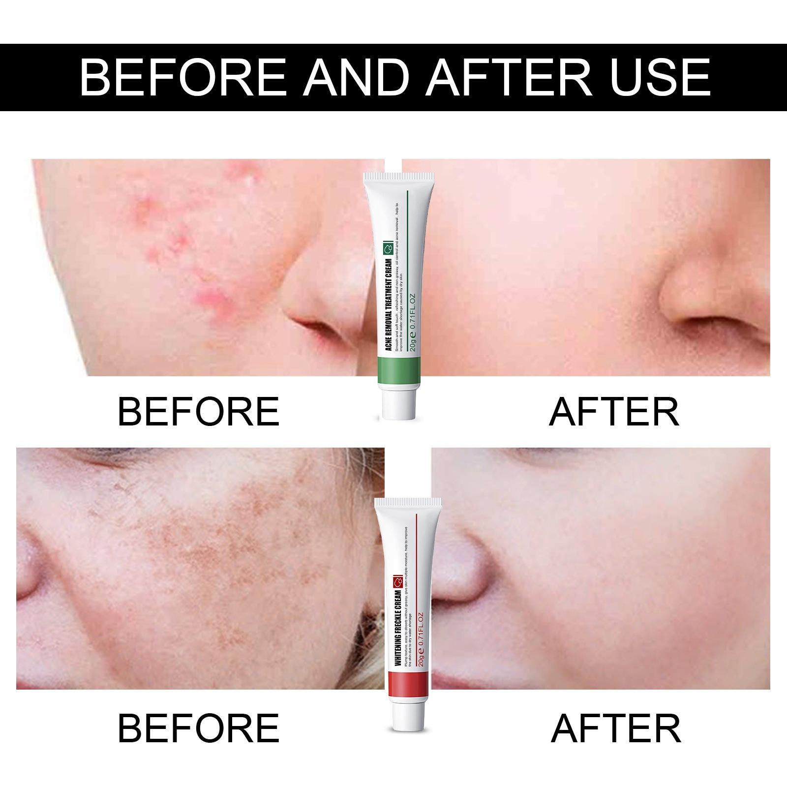 4xFreckle Cream Moisturizer Repair Cream for Melasma Dark Spots Moisturizing