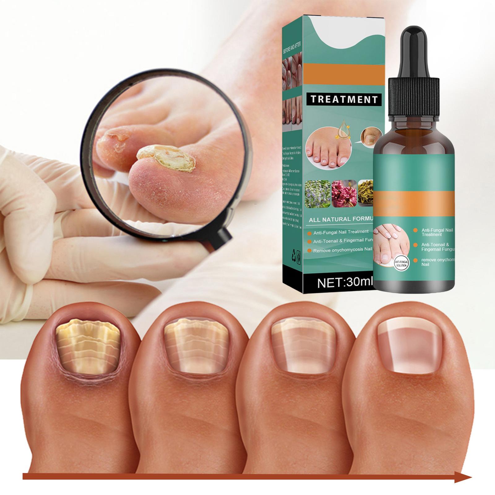 2xFoot Nail Lotion Removal Gel for Nail Problem Thickening and Yellowing