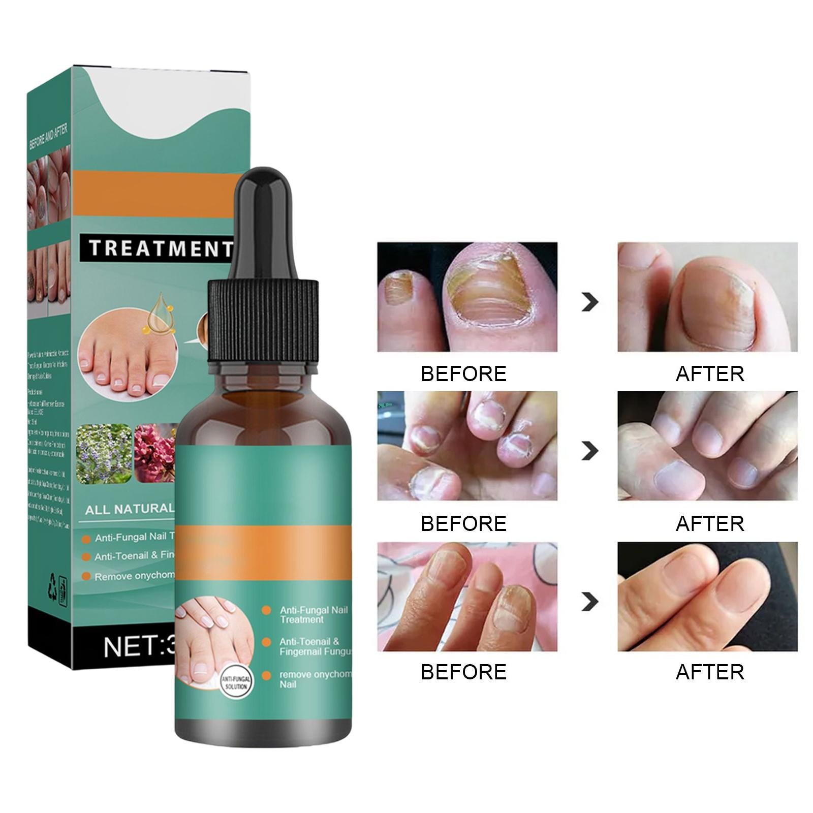 2xFoot Nail Lotion Removal Gel for Nail Problem Thickening and Yellowing