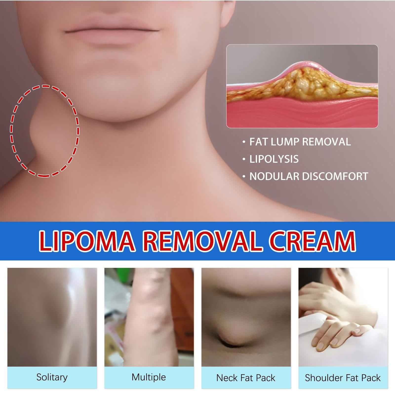 20g Lipoma Removal Cream Mild Easy to Use Care Cream Wide Applaications