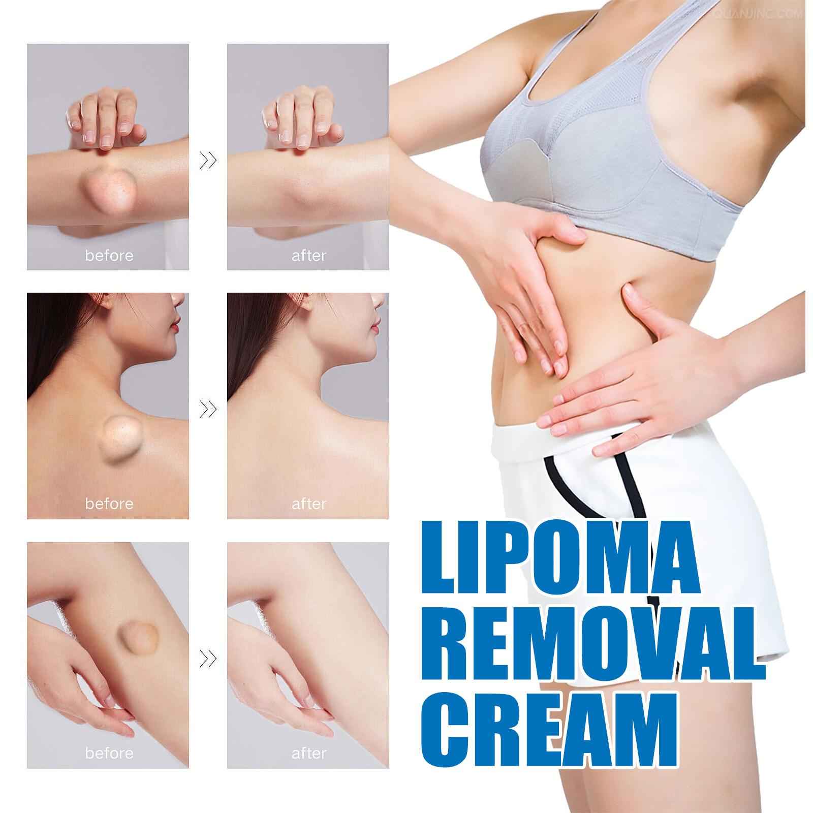20g Lipoma Removal Cream Mild Easy to Use Care Cream Wide Applaications