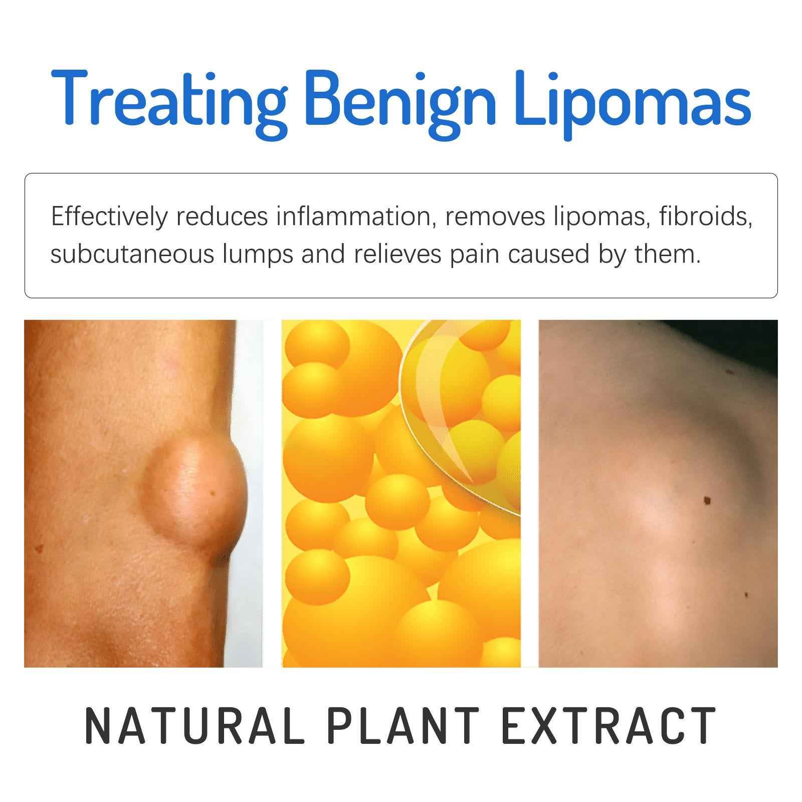 20g Lipoma Removal Cream Mild Easy to Use Care Cream Wide Applaications