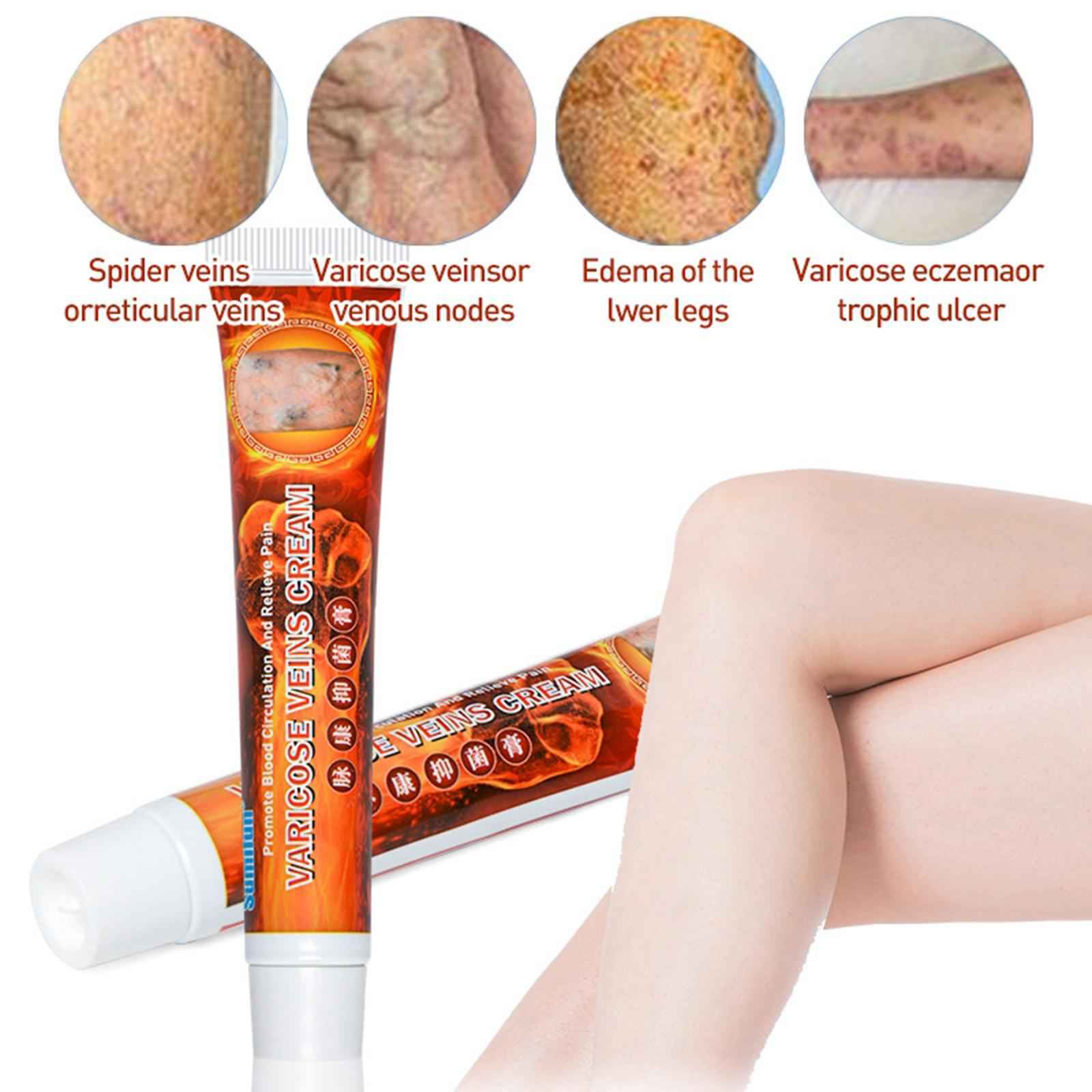 Natural Plant Varicose Veins Treatment Cream Ointment Leg Phlebitis Removal