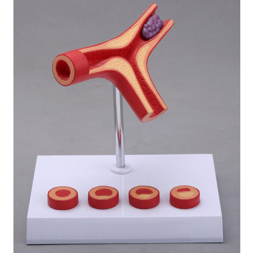 Human Vessel Anatomical Model Atherosclerosis Model Medical Training Model