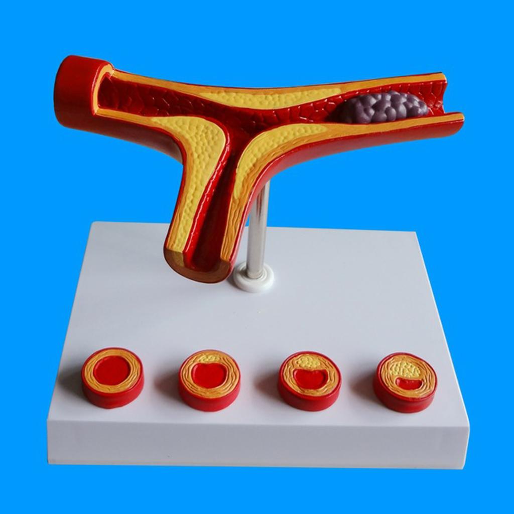 Human Vessel Anatomical Model Atherosclerosis Model Medical Training Model