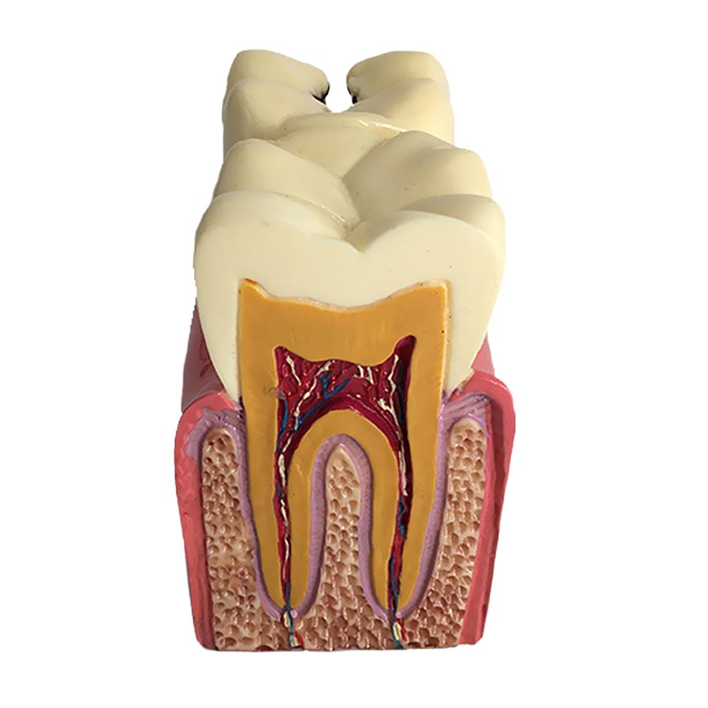 Teeth Model 6 Times Caries Comparation Study Models Studying and Researching