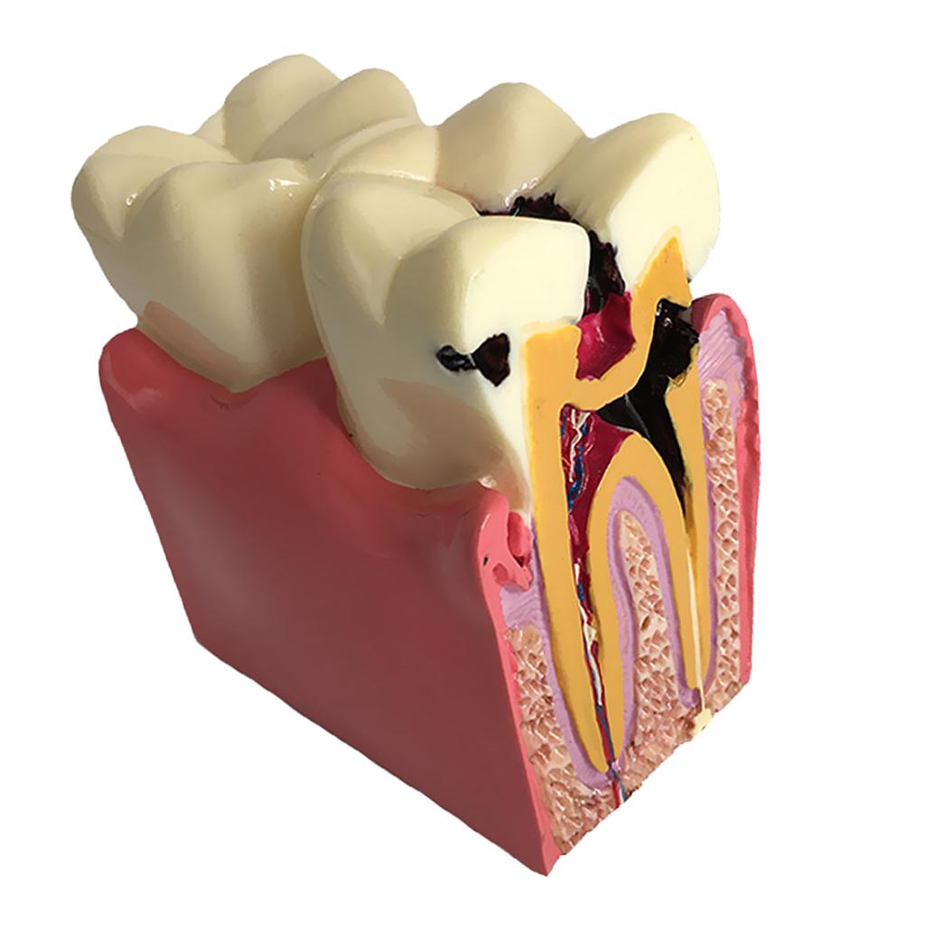 Teeth Model 6 Times Caries Comparation Study Models Studying and Researching