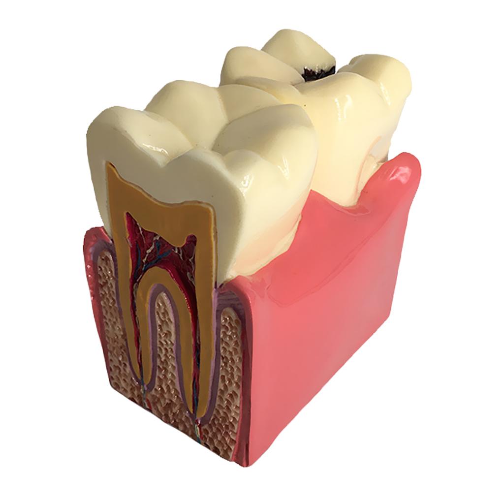 Teeth Model 6 Times Caries Comparation Study Models Studying and Researching