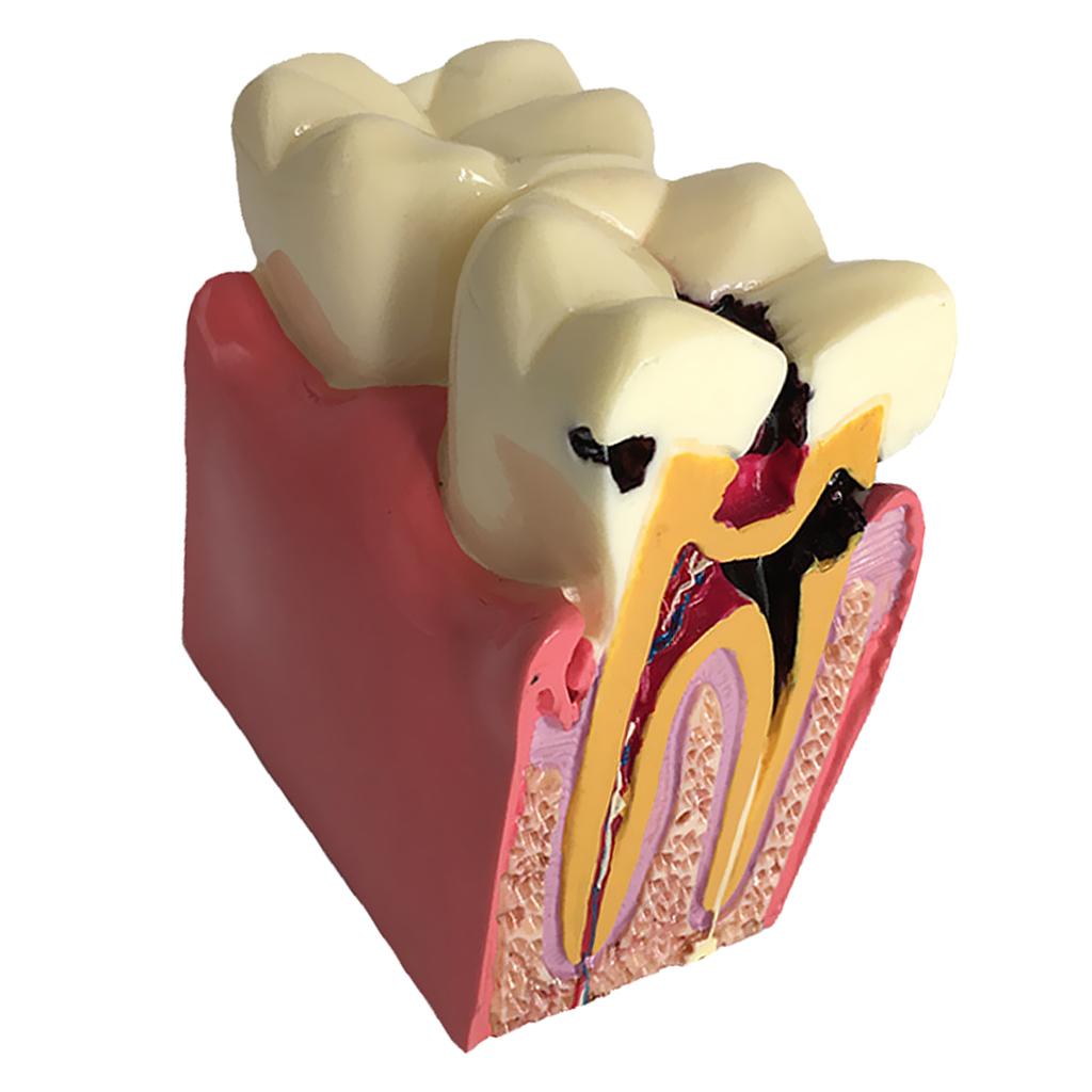 Teeth Model 6 Times Caries Comparation Study Models Studying and Researching