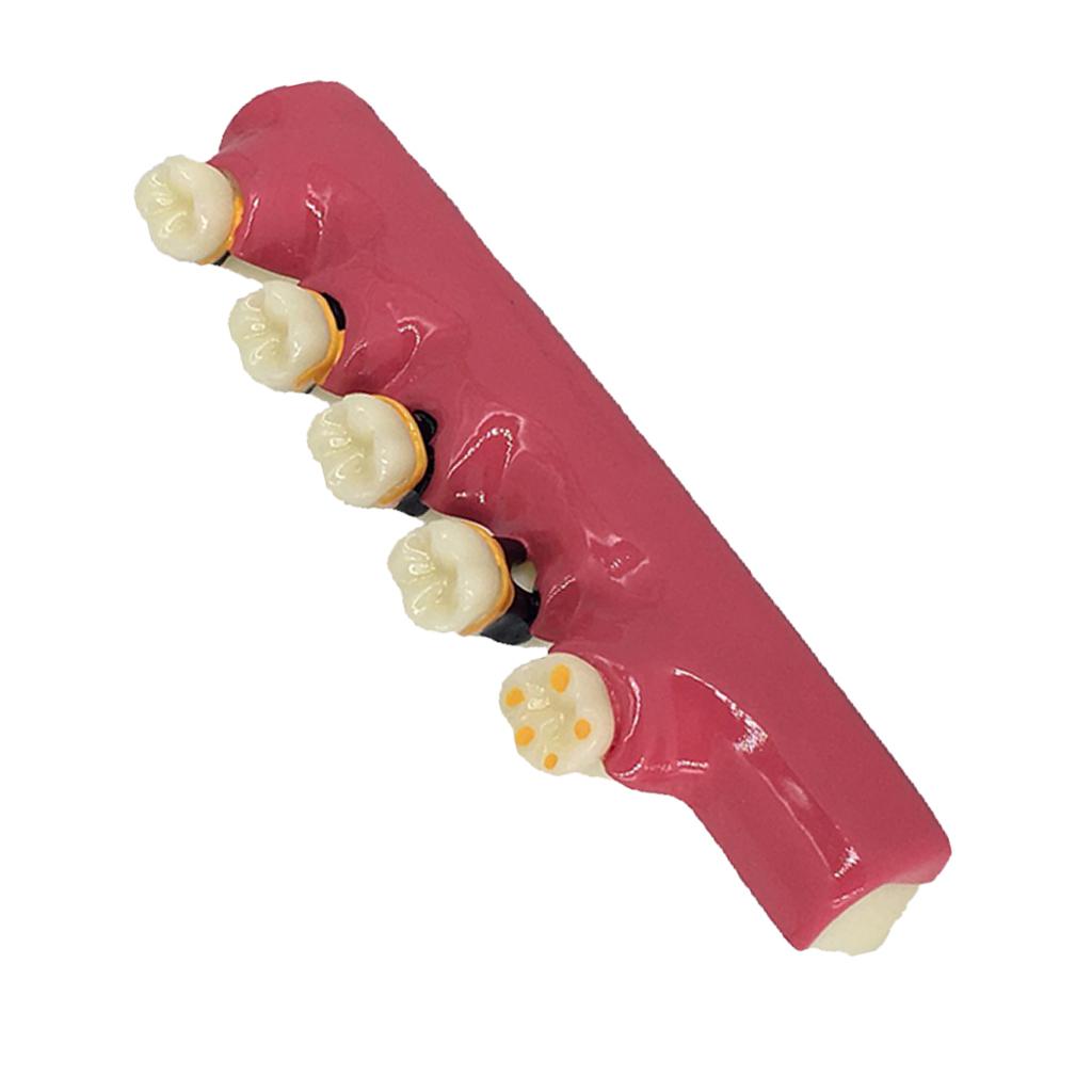 1Pc Dental Caries Developing Illustration Teeth Disease Tooth Model