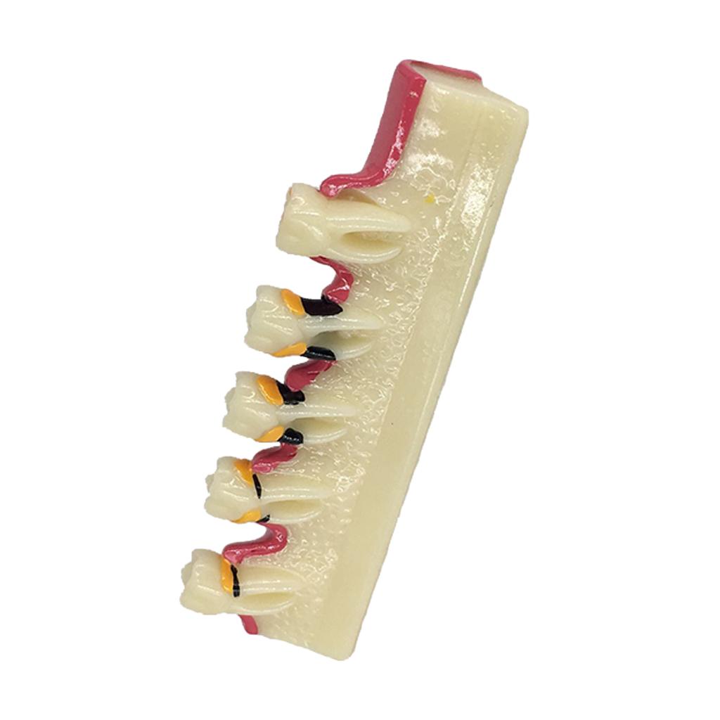 1Pc Dental Caries Developing Illustration Teeth Disease Tooth Model