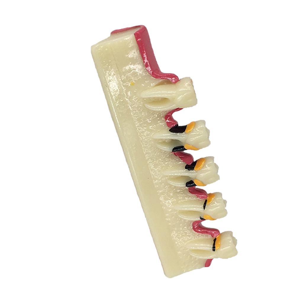 1Pc Dental Caries Developing Illustration Teeth Disease Tooth Model