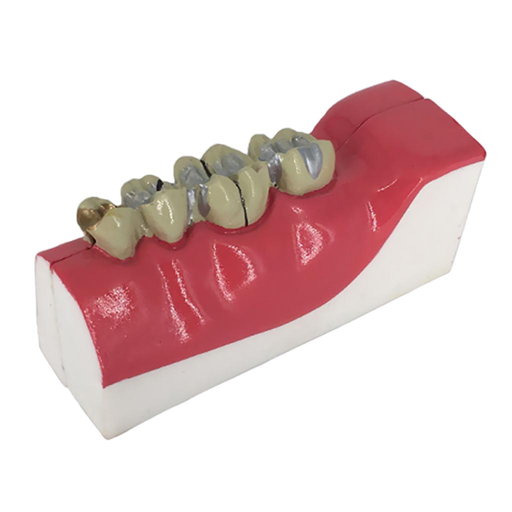 Teeth Model Lower Right Posterior Teeth Tissue Decomposition Model