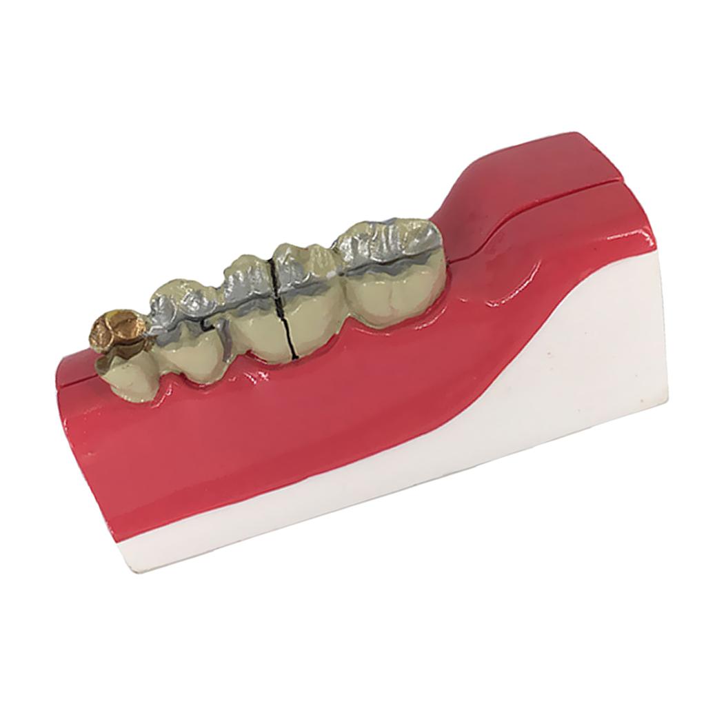 Teeth Model Lower Right Posterior Teeth Tissue Decomposition Model