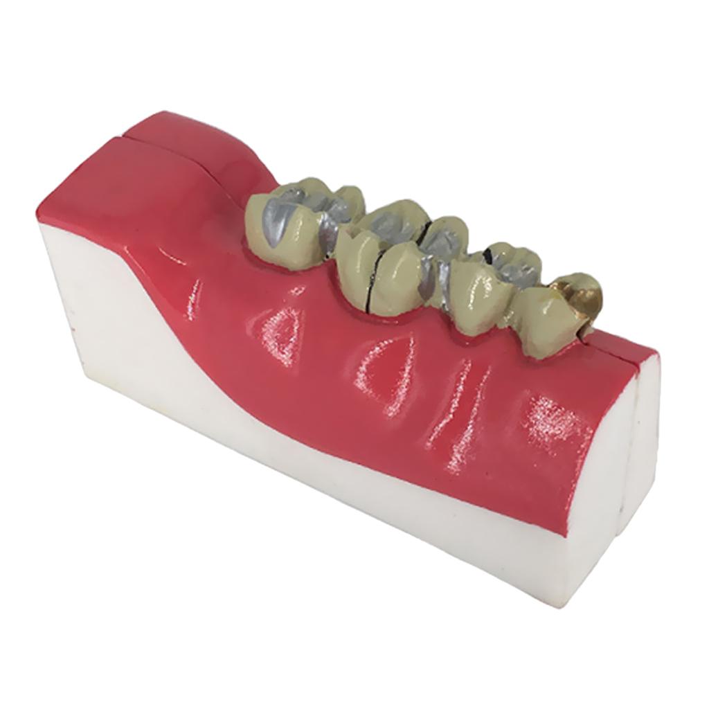 Teeth Model Lower Right Posterior Teeth Tissue Decomposition Model