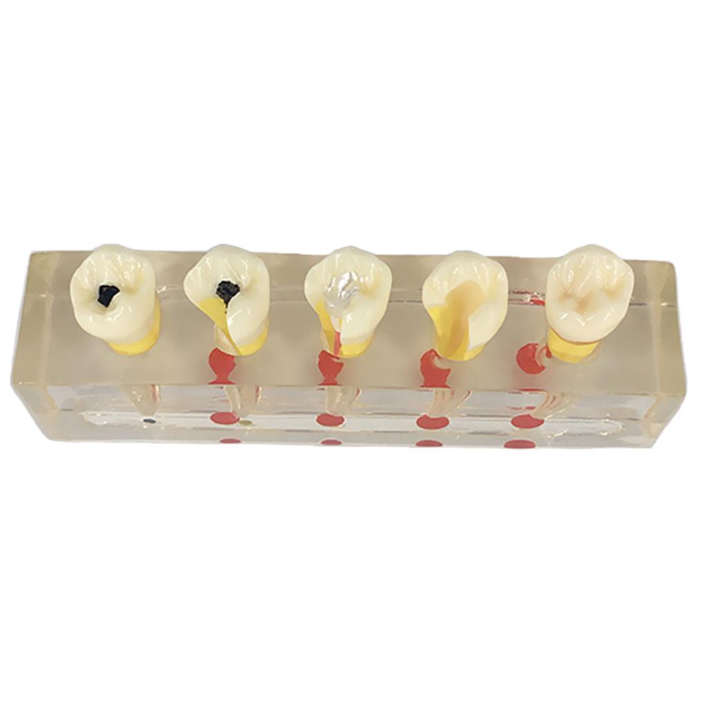 Teeth Pulp Disease Clinical Model for Teeth Teaching Learning