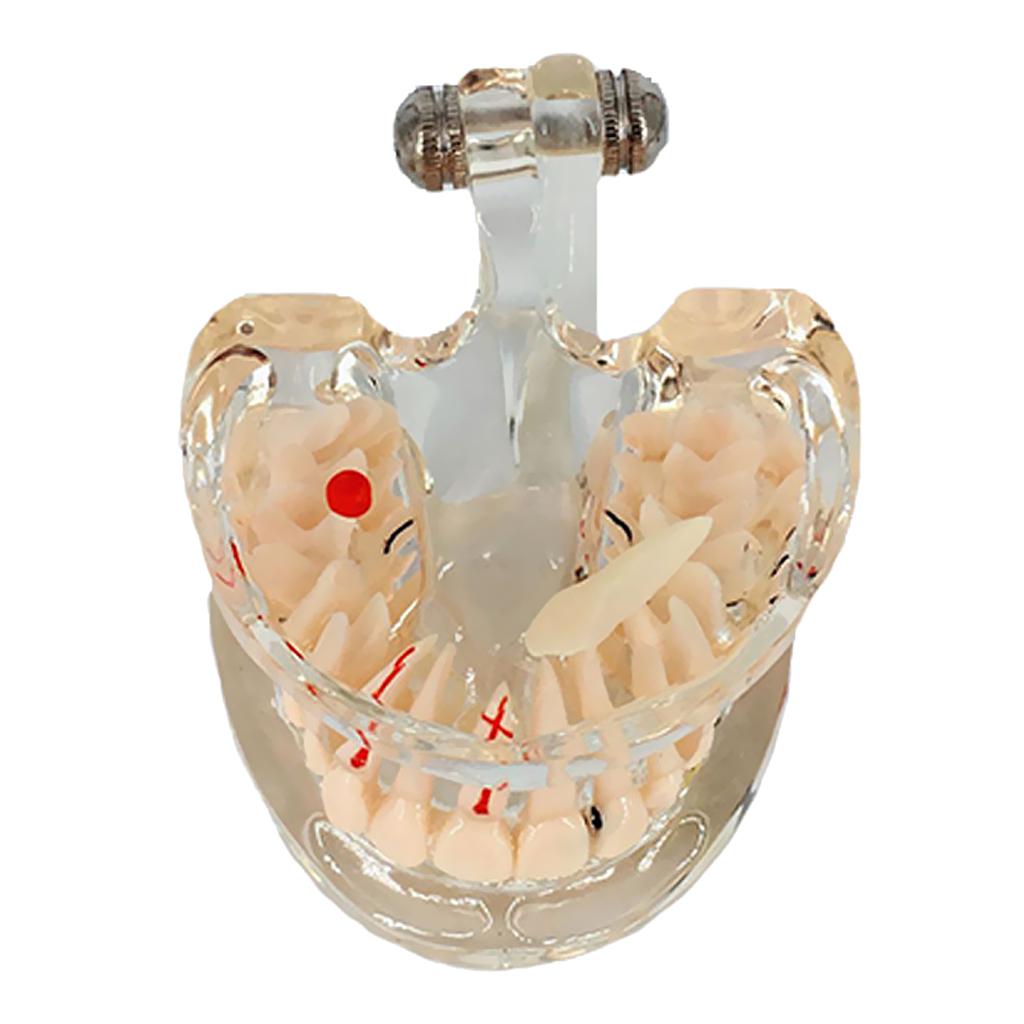 Dental Implant Disease Teeth Model With Restoration Bridge Tooth