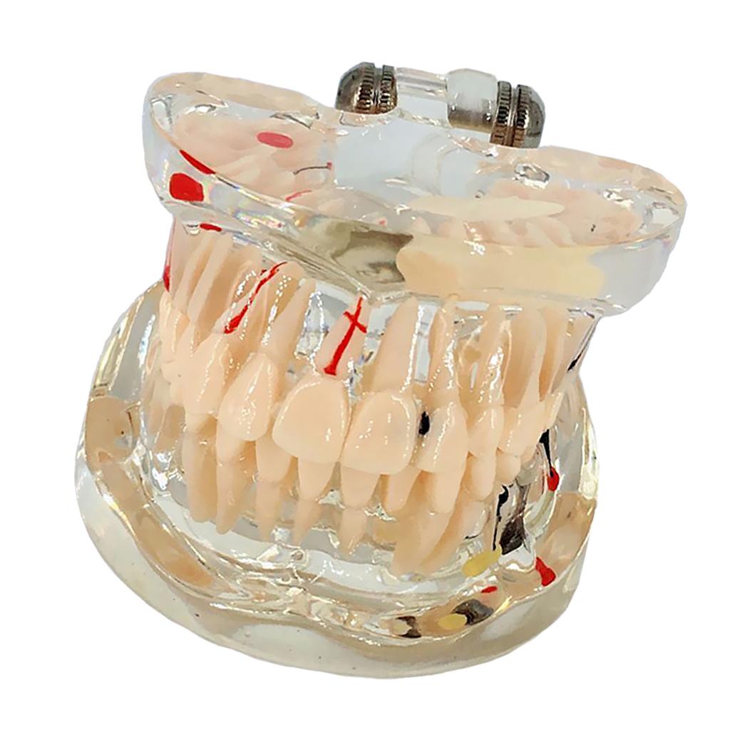 Dental Implant Disease Teeth Model With Restoration Bridge Tooth