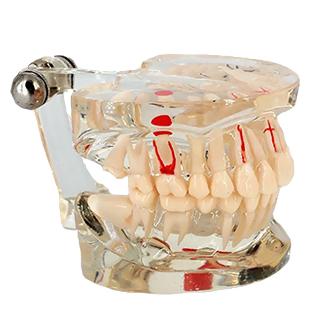 Dental Implant Disease Teeth Model With Restoration Bridge Tooth