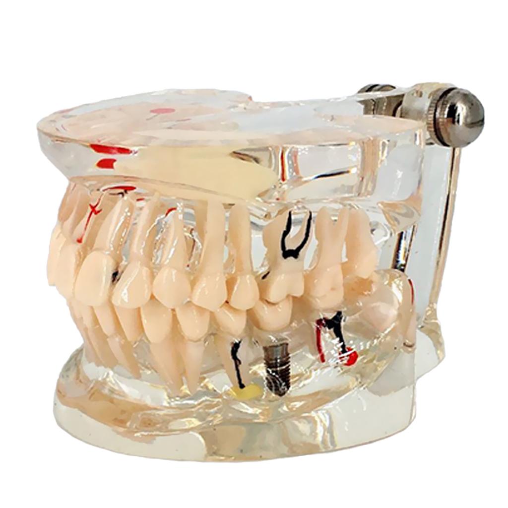 Dental Implant Disease Teeth Model With Restoration Bridge Tooth