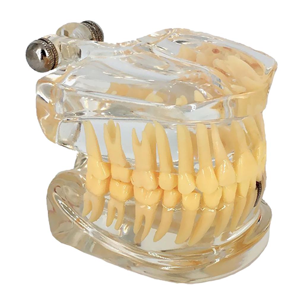 Dental Implant Disease Teeth Model Left Face With Restoration Bridge Tooth