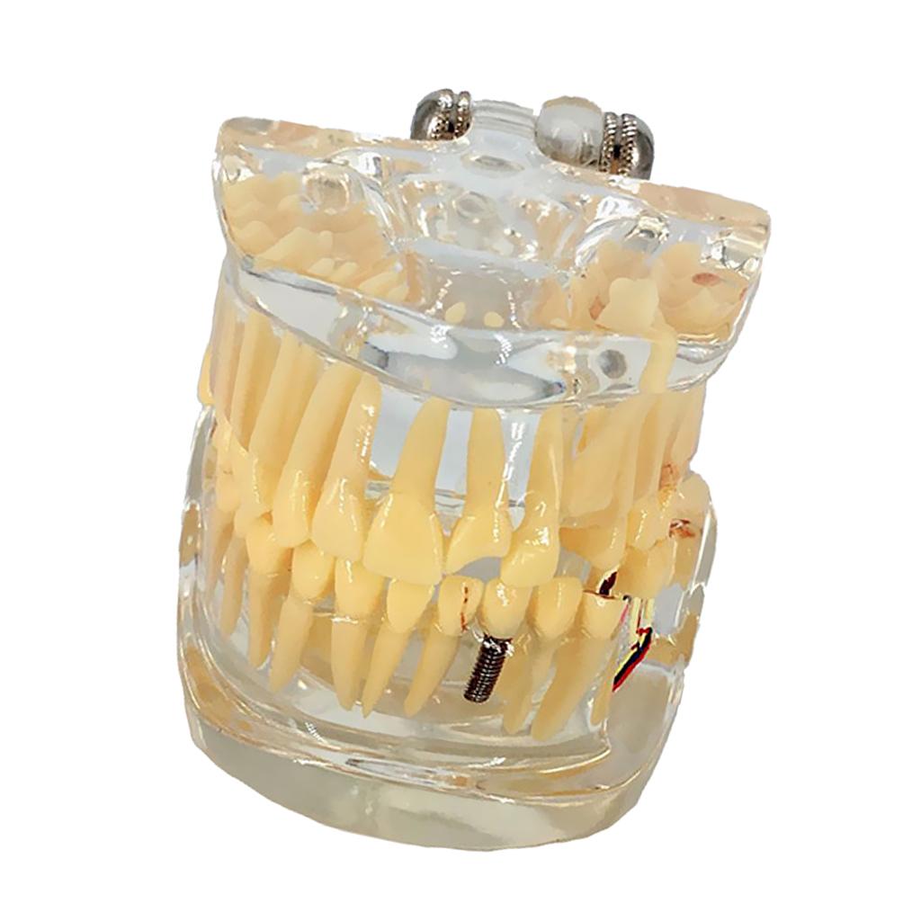 Dental Implant Disease Teeth Model Left Face With Restoration Bridge Tooth