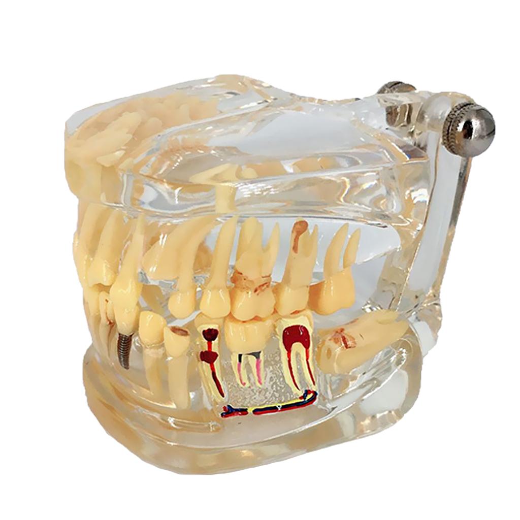 Dental Implant Disease Teeth Model Left Face With Restoration Bridge Tooth