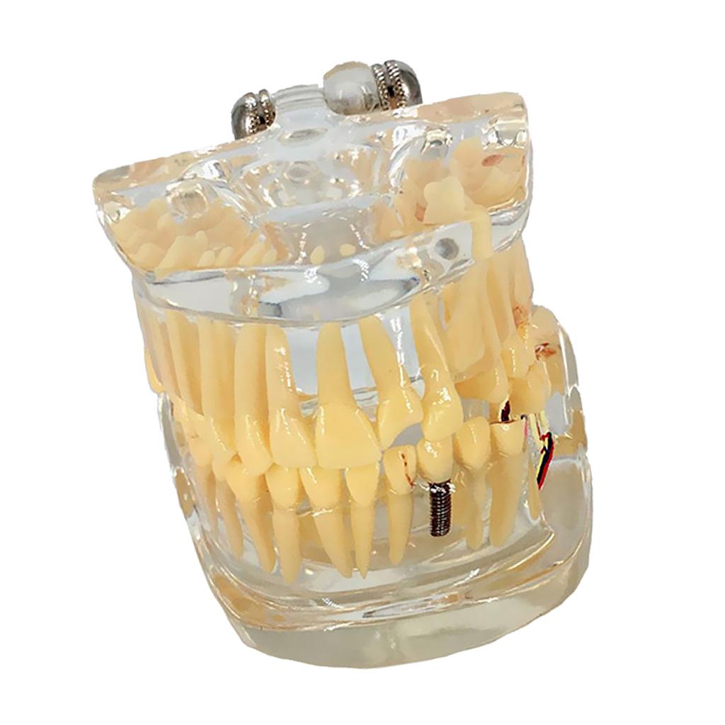 Dental Implant Disease Teeth Model Left Face With Restoration Bridge Tooth