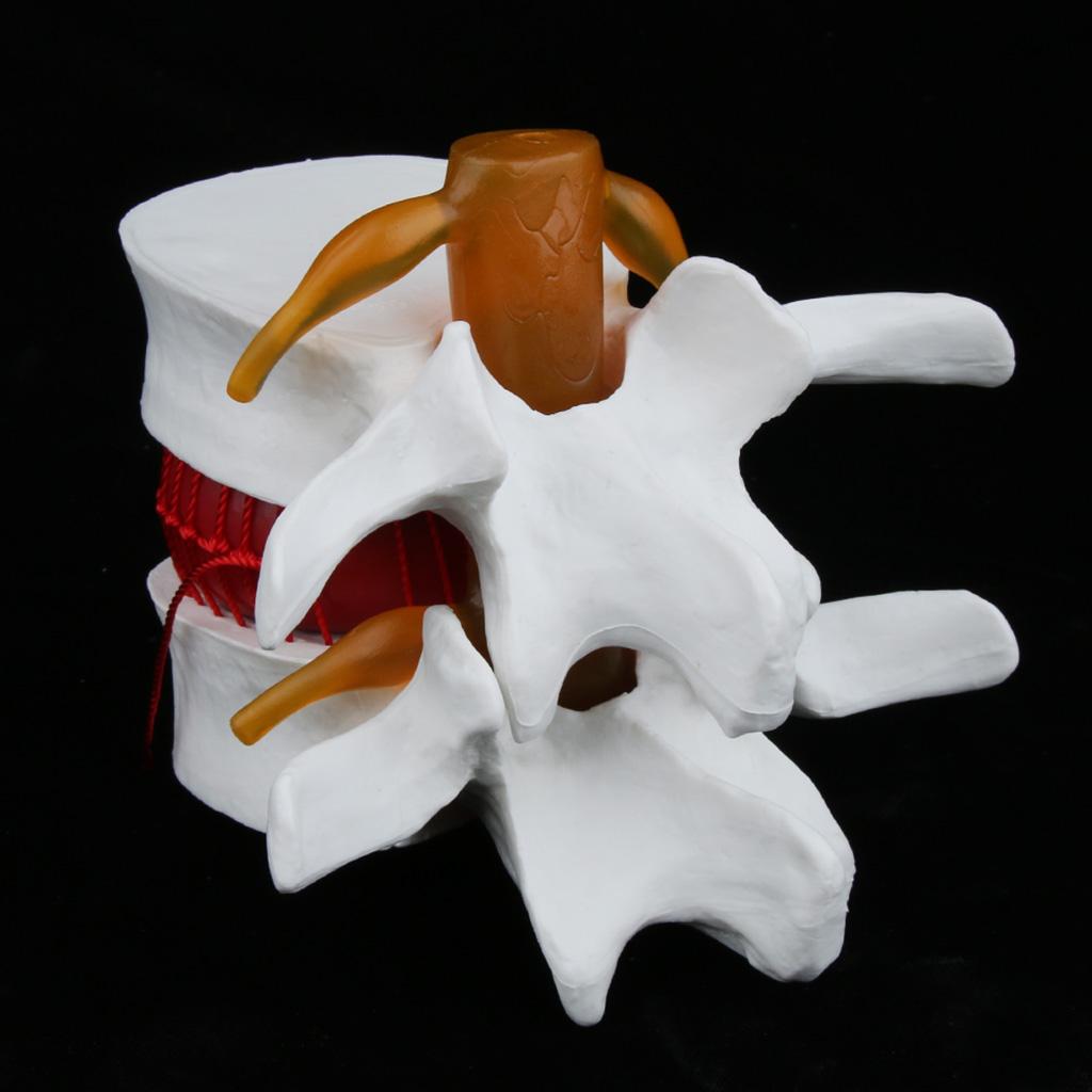 Human Spine Lumbar Intervertebral Disc Protrusion Model Magnification 1.5x