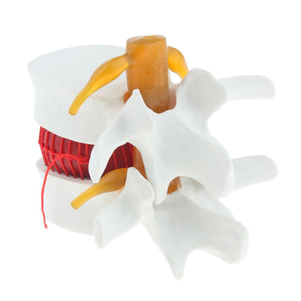 Human Spine Lumbar Intervertebral Disc Protrusion Model Magnification 1.5x