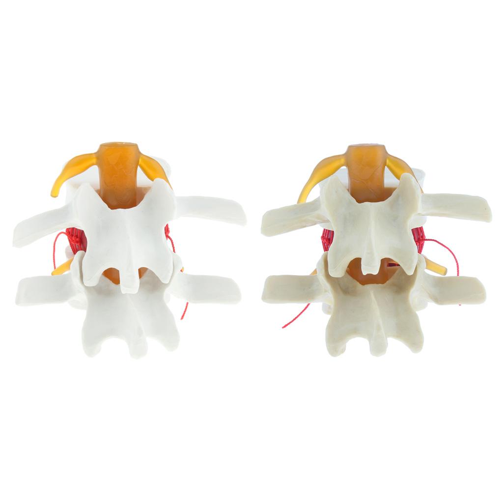 Human Spine Lumbar Intervertebral Disc Protrusion Model Magnification 1.5x