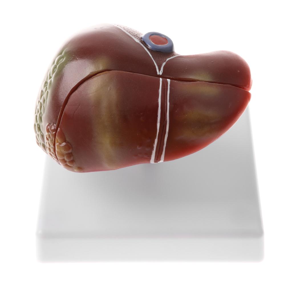 Human Diseased Liver Pathological Anatomical Model, Lab Medical Equipment