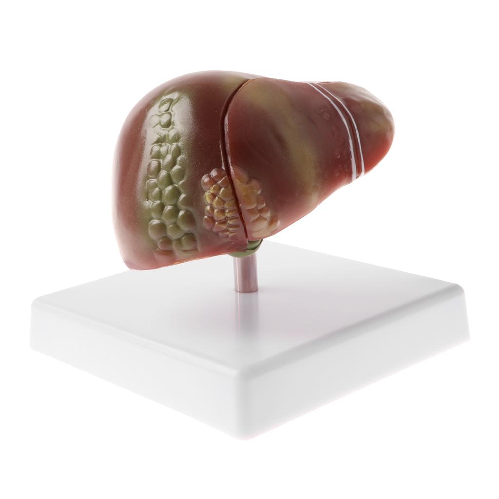 Human Diseased Liver Pathological Anatomical Model, Lab Medical Equipment