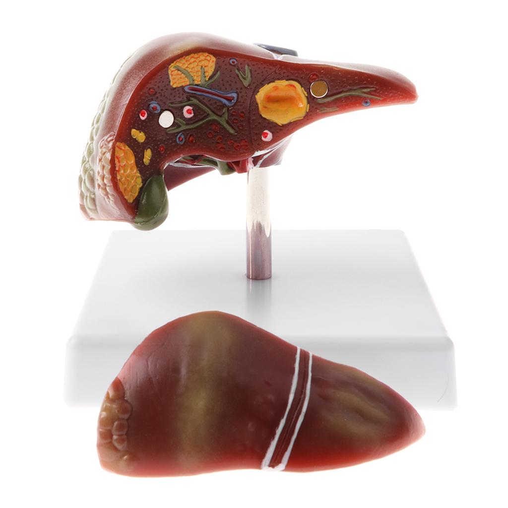 Human Diseased Liver Pathological Anatomical Model, Lab Medical Equipment