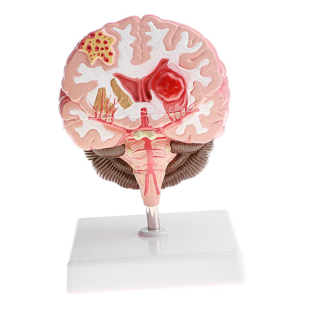 Anatomical Human Brain Disease Pathological Model Medical Teaching Tool Lab