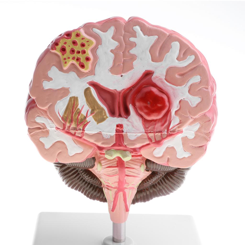 Anatomical Human Brain Disease Pathological Model Medical Teaching Tool Lab