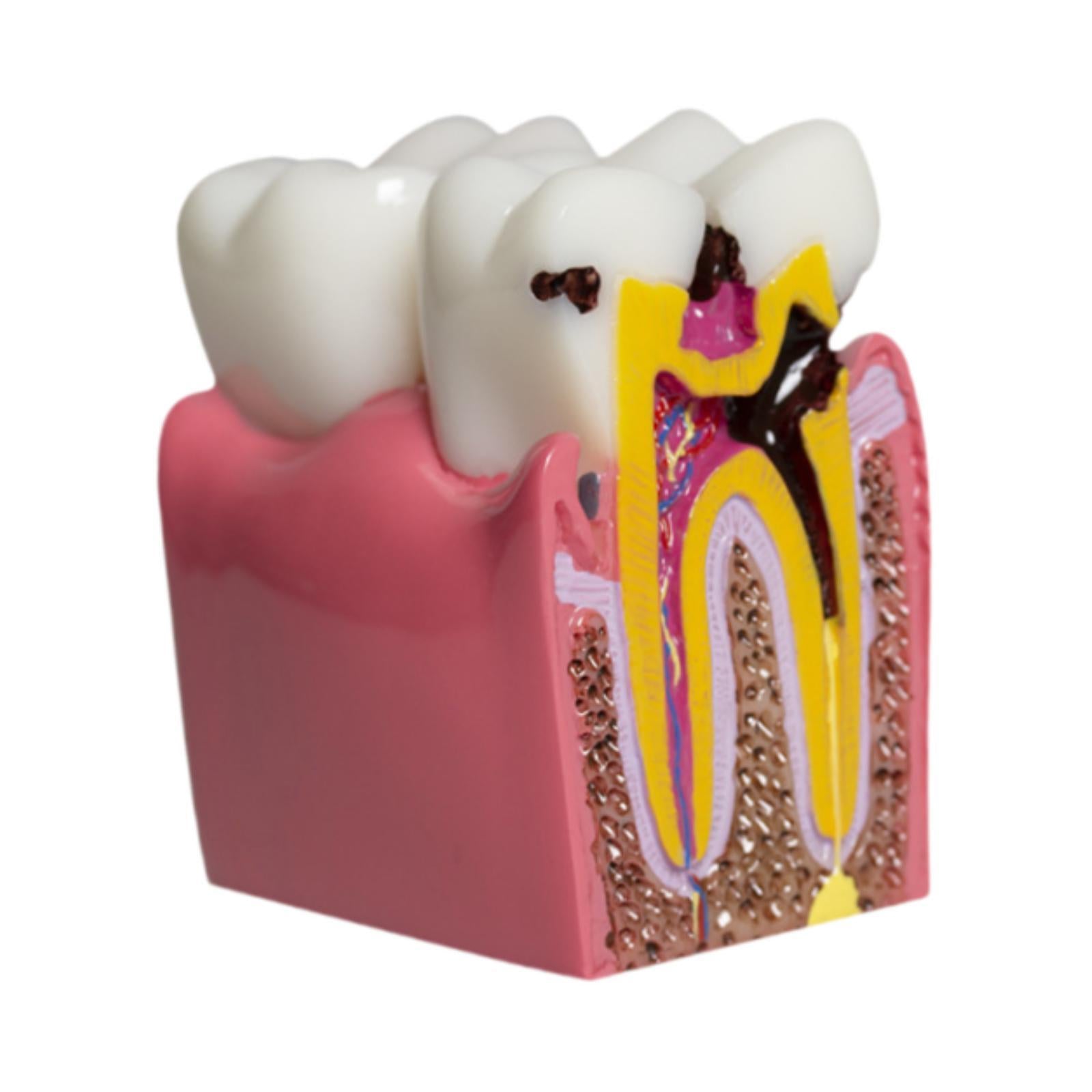 6 Times Caries Tooth Model Teaching Aid for Demonstration Classroom Teachers