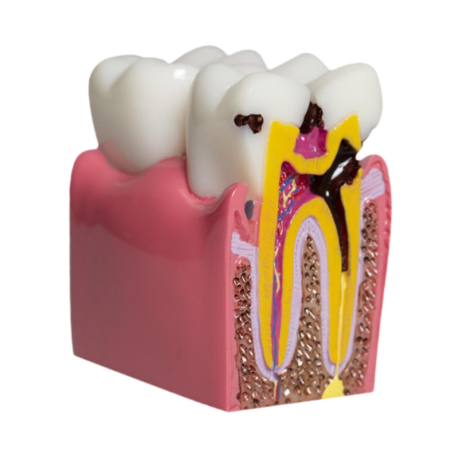 6 Times Caries Tooth Model Teaching Aid for Demonstration Classroom Teachers