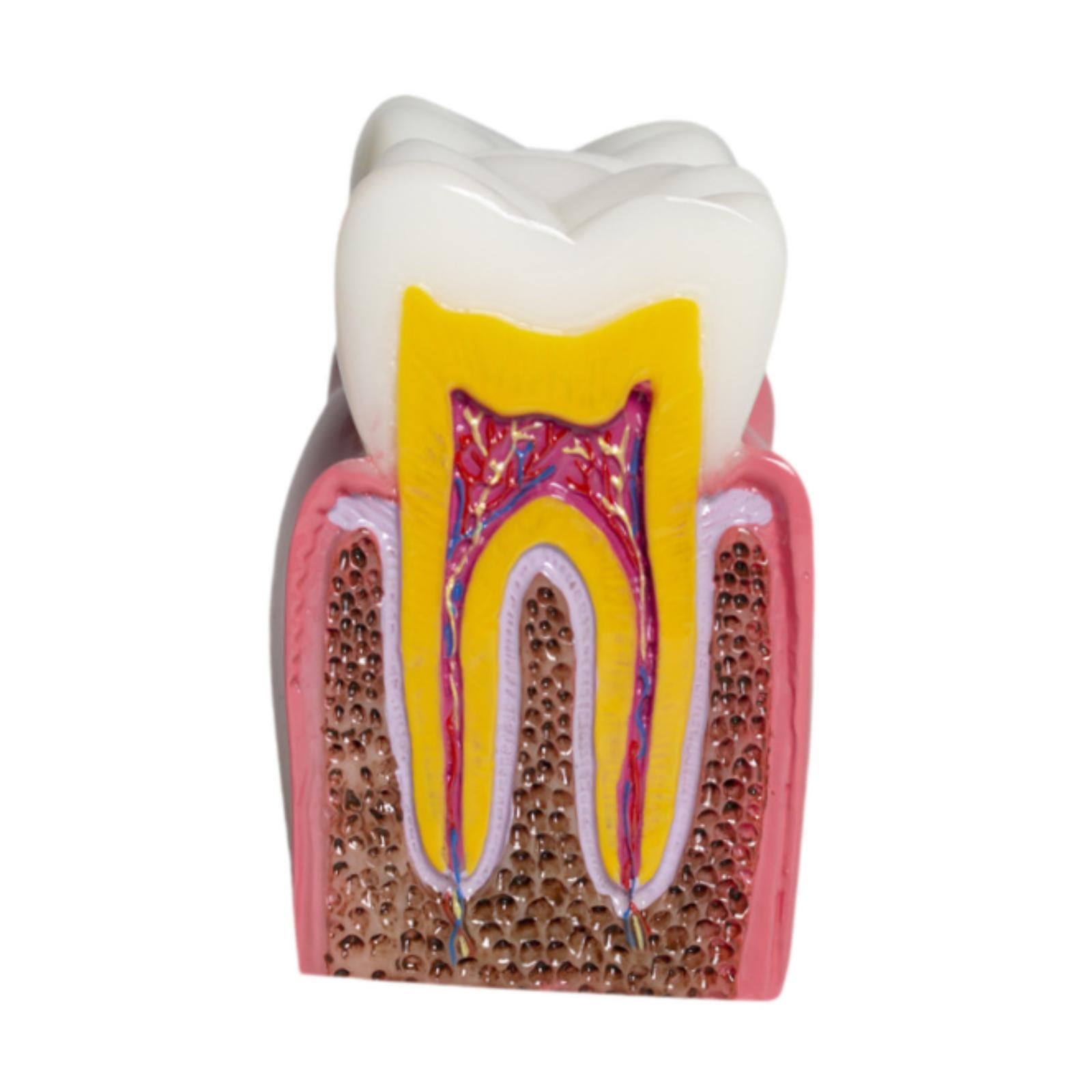 6 Times Caries Tooth Model Teaching Aid for Demonstration Classroom Teachers