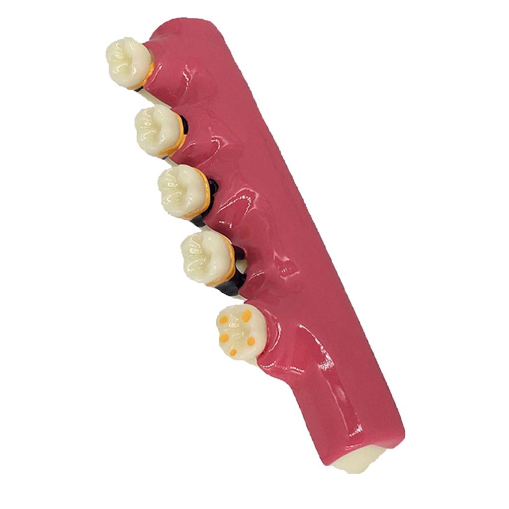 1Pc Dental Caries Developing Illustration Teeth Disease Tooth Model