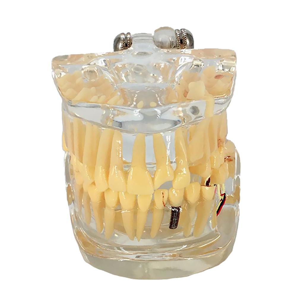 Dental Implant Disease Teeth Model Left Face With Restoration Bridge Tooth