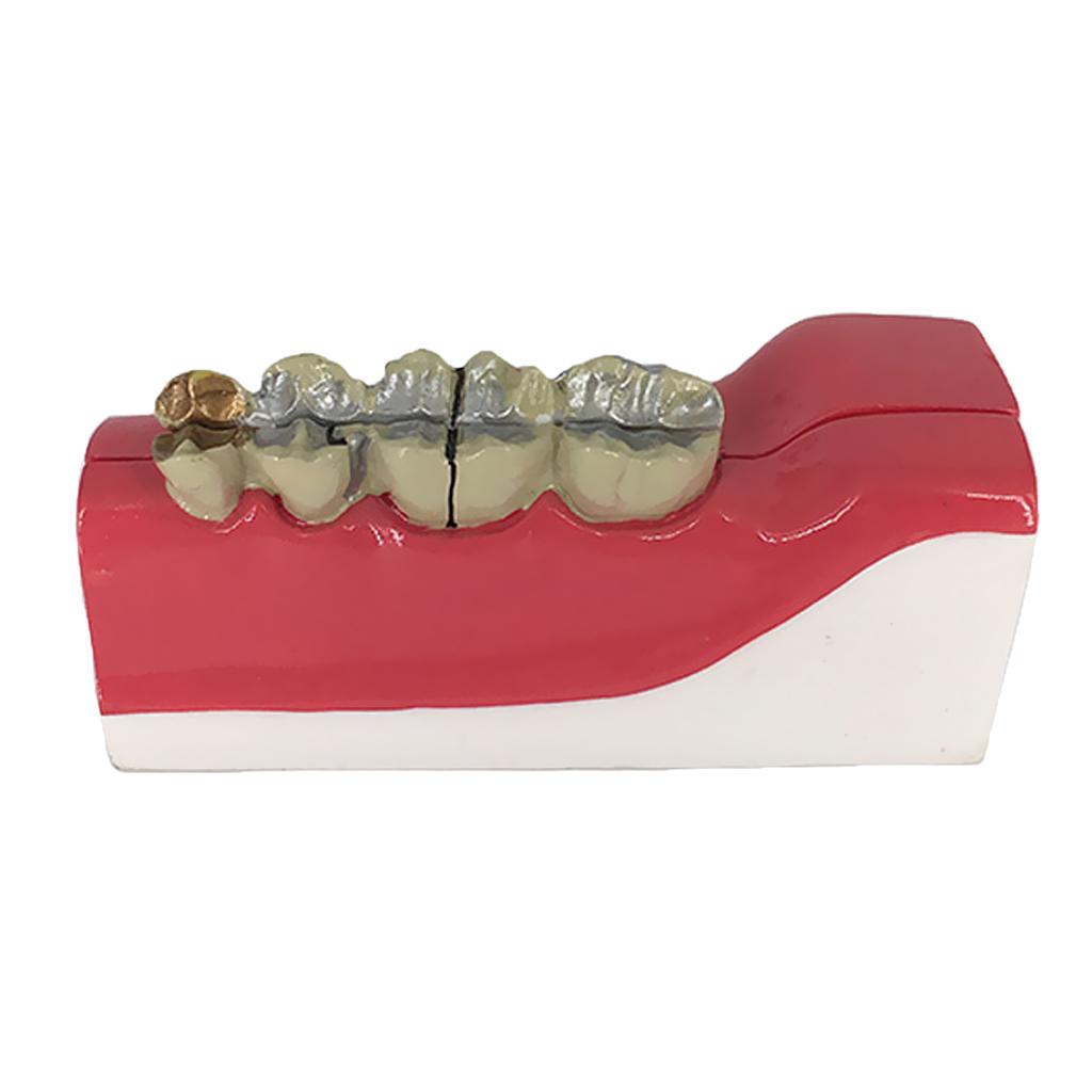 Teeth Model Lower Right Posterior Teeth Tissue Decomposition Model