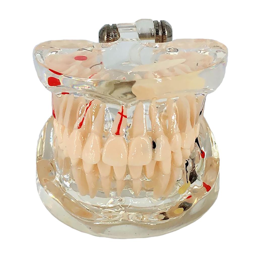 Dental Implant Disease Teeth Model With Restoration Bridge Tooth