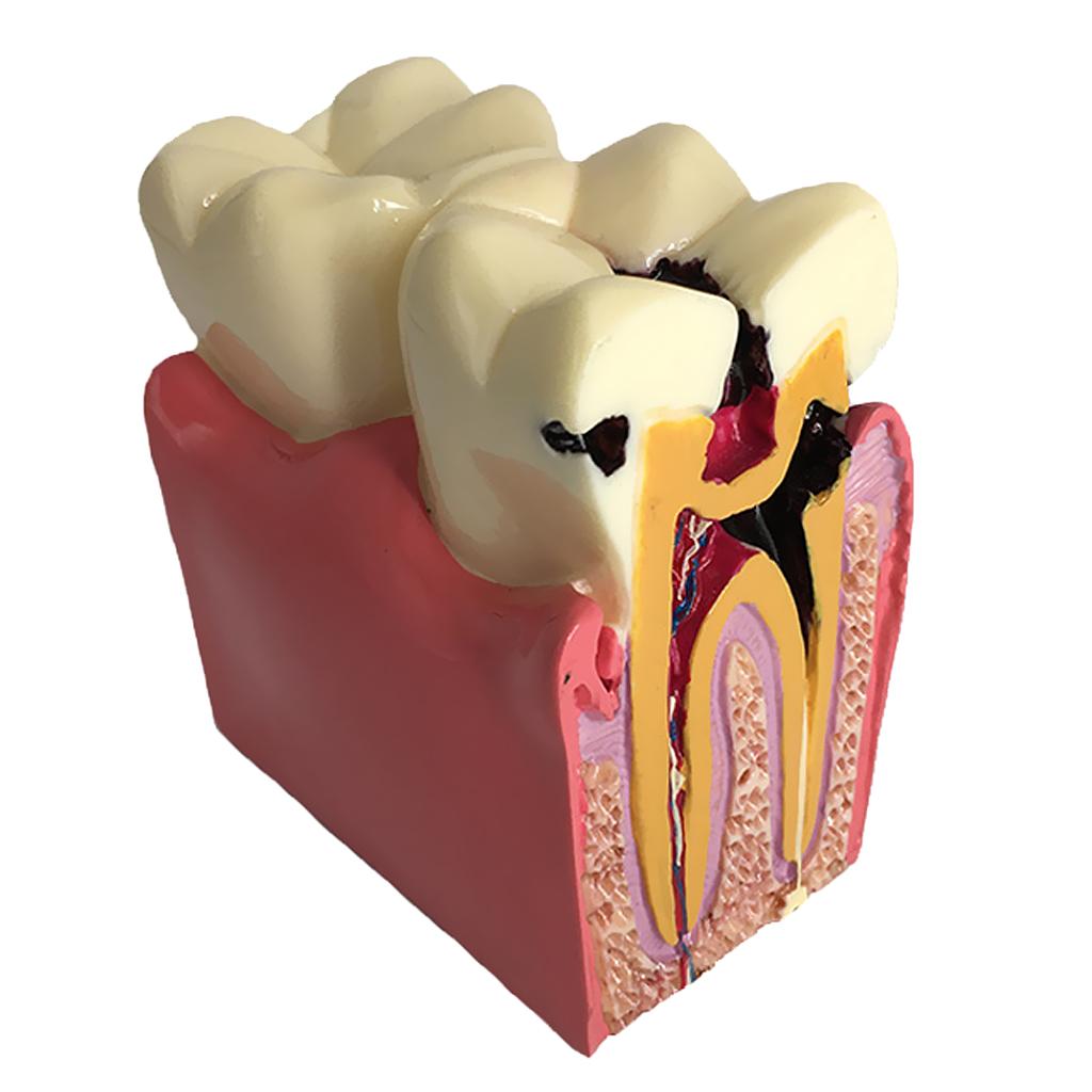 Teeth Model 6 Times Caries Comparation Study Models Studying and Researching