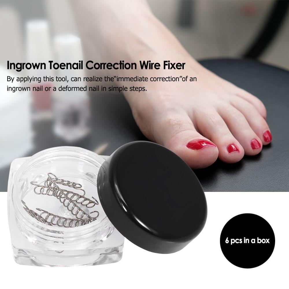 6Pcs/Box Ingrown Toenail Correction Wire Fixer Ingrown Toe