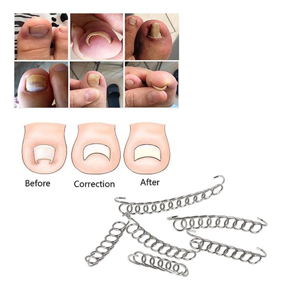 6Pcs/Box Ingrown Toenail Correction Wire Fixer Ingrown Toe