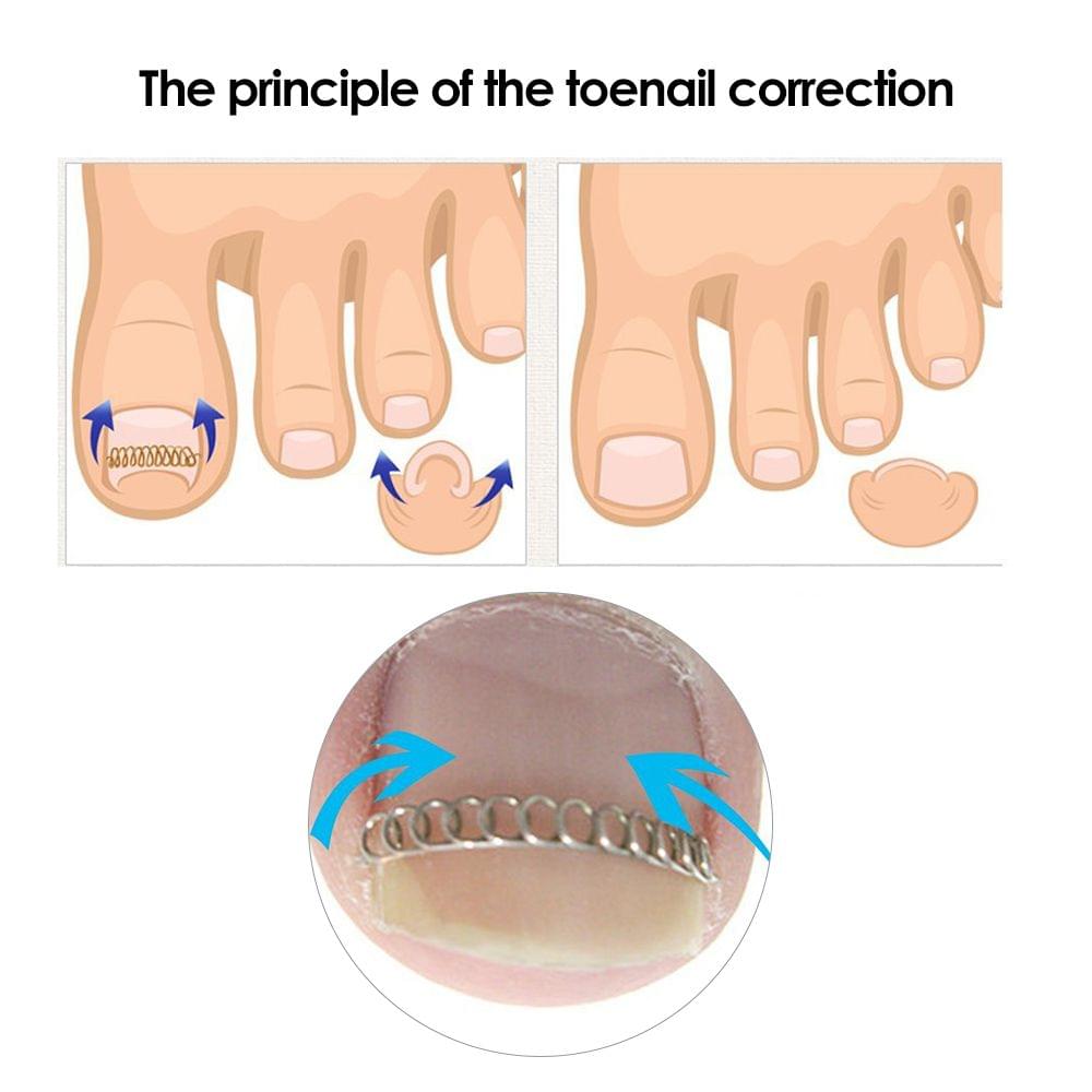 6Pcs/Box Ingrown Toenail Correction Wire Fixer Ingrown Toe